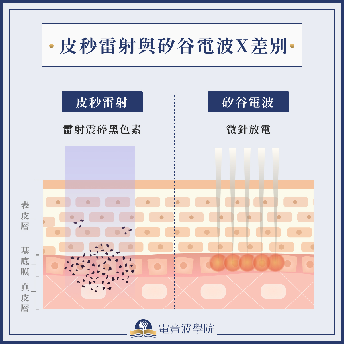 皮秒雷射、矽谷電波x 比較