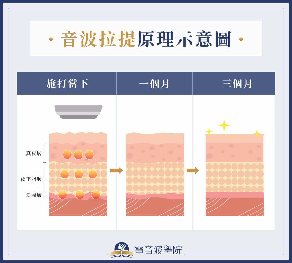 音波拉提原理示意圖