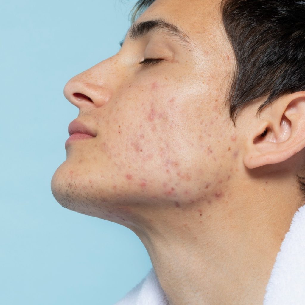 痘疤怎消除？凹痘疤有解嗎？分析 3 大痘疤種類、教你對症處置方法