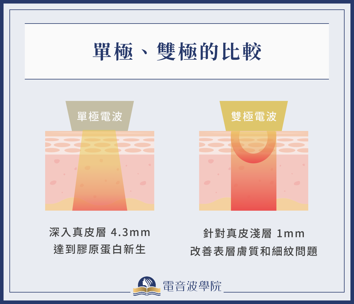 單極、雙極電波比較